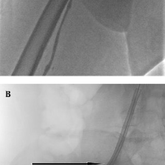 Thrombolysis in an Ankylosing Spondylitis Patient  {faces}